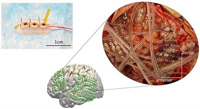 Decoding Speech With Integrated Hybrid Signals Recorded From the Human Ventral Motor Cortex